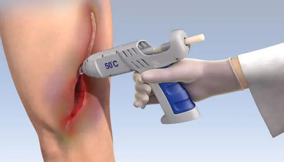 A Hot Medical Glue Gun to Heal Injuries
