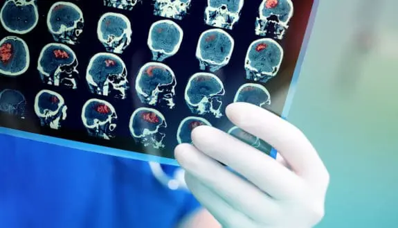 Stroke Warning: How AI Can Help