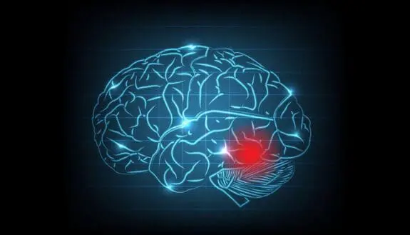 Wearable Device Predicts Stroke