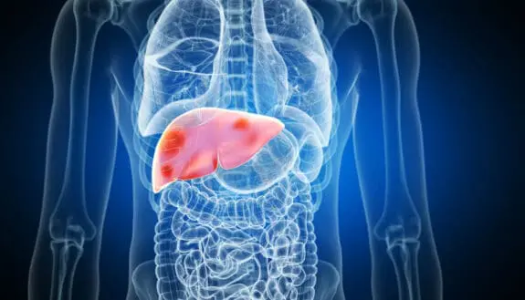 Liver Tumor Treatment Gets a High-Tech Upgrade
